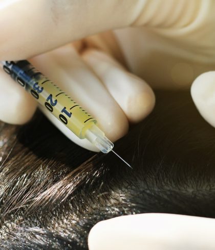 Doctor injecting at patient's hair and scalp, Dermatologist exam scalp disorder. (Selective Focus)